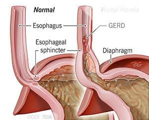 ग्यास्ट्रिक भनेर झुक्किने रोग : जिइआरडी (रिफ्लक्स)
