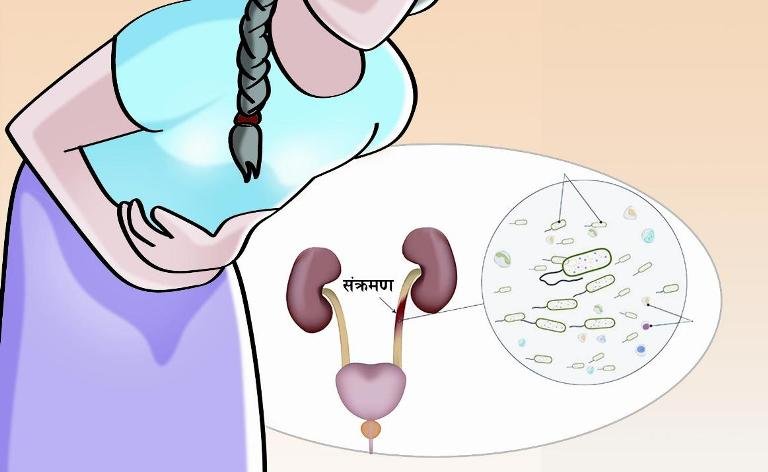 गर्भावस्थामा मूत्रनली संक्रमण